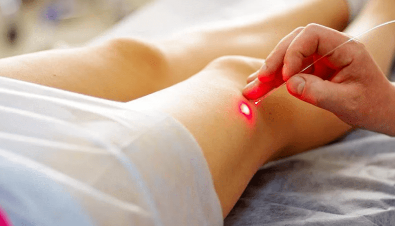 Laser Kotagulatioun vu Variikose Venen