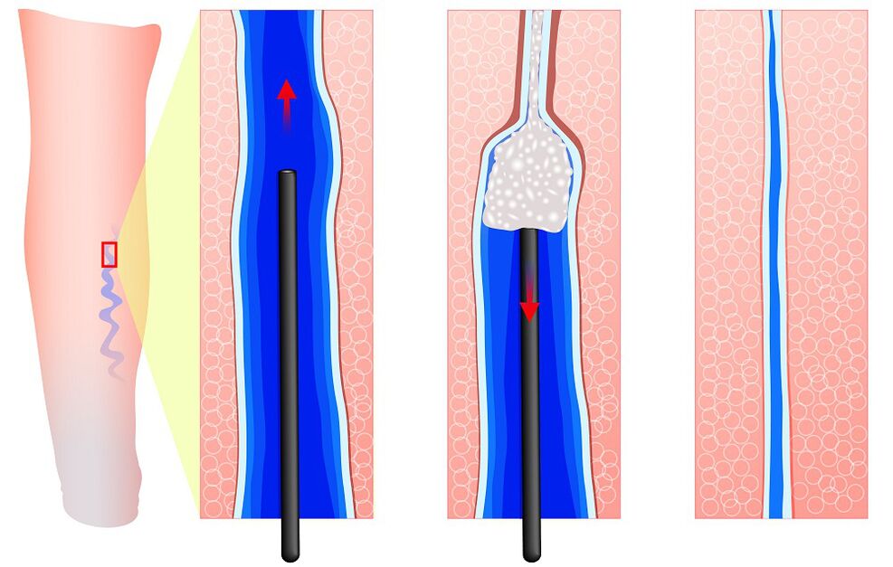 Mechanismus vun der Sklerotherapie